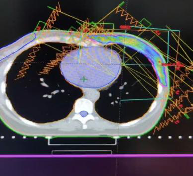 乳腺癌放疗定位图图片